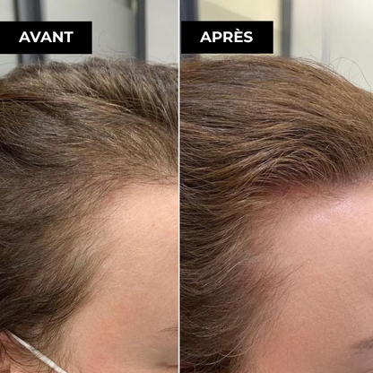 Folissence - Kit Micro-Infusion