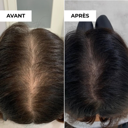 Folissence - Kit Micro-Infusion